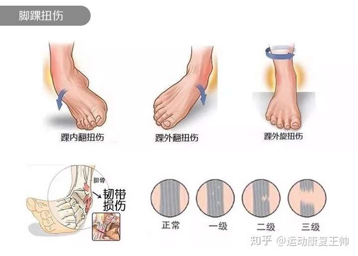 脚踝韧带拉伤多久能好 本人已经三个月了 正常运动我都可以 就是不能