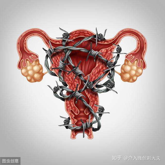 子宫腺肌症的临床分型与治疗方式