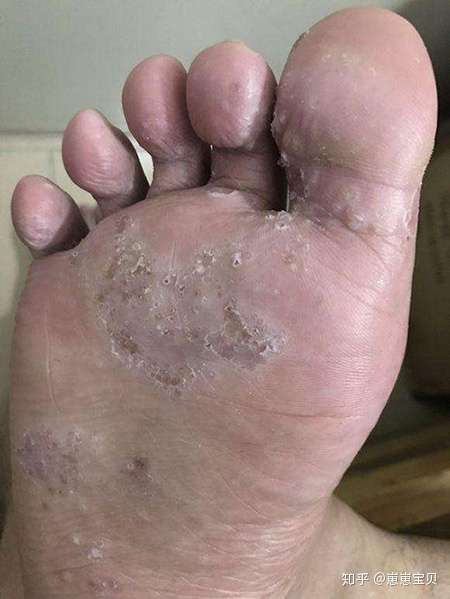 一,水疱型脚气  这类脚气的症状为足底和足缘部的硬皮水疱,水疱壁不