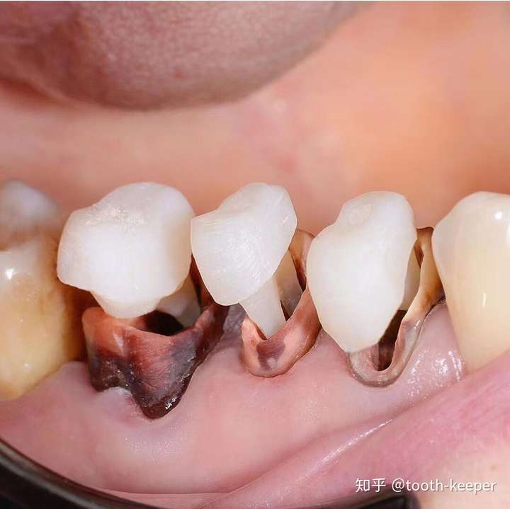 口腔医生来给大家解释一个关于根管治疗后的牙齿要不要做修复以及
