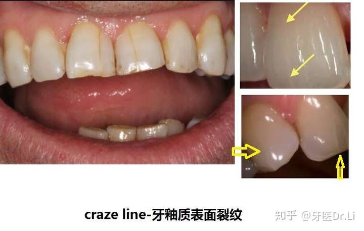 太恐怖了牙齿上有裂纹