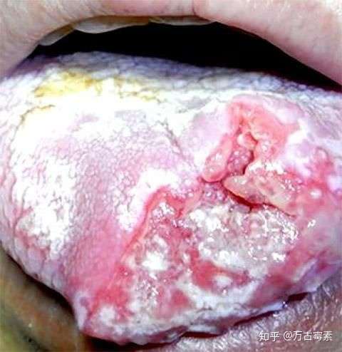 舌癌晚期是什么样的?