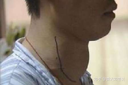 首大赵桂丽:甲状腺肿大怎么办