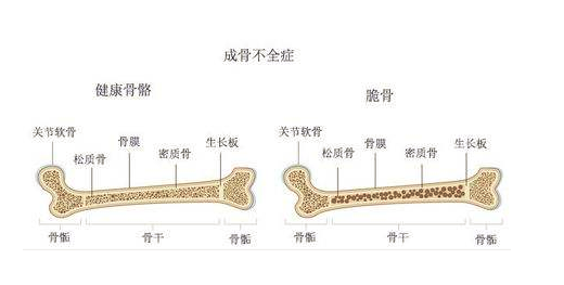 成骨不全症如何避免遗传