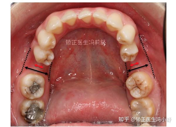 牙齿拔掉后,因为没有牙齿的功能性刺激,缺牙区的牙槽骨会持续性萎缩