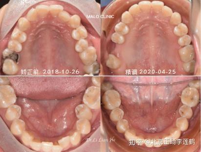 北京牙齿矫正:|虎牙外凸 牙列拥挤|正畸案例