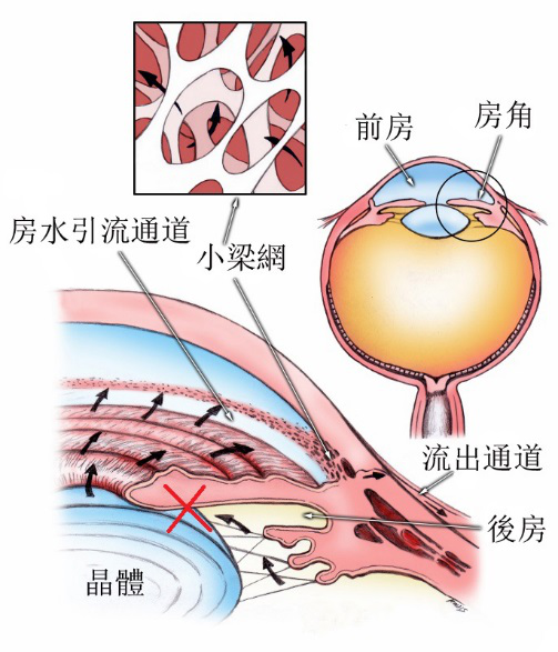 什么得了青光眼医生却让我做白内障手术