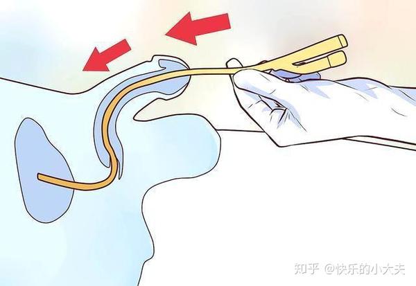 医生提醒:7种情况要留尿管,4种办法缓解不适感