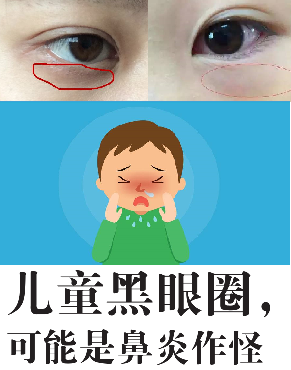 影响孩子颜值的黑眼圈如何治疗过敏性鼻炎所致黑眼圈调理方法