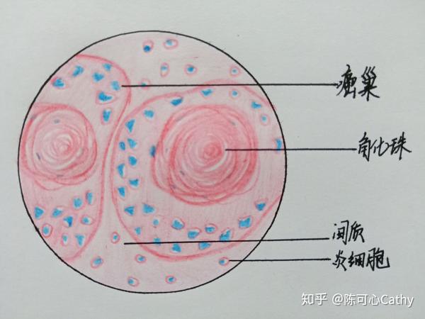 病理学红蓝铅笔绘图 实验作业