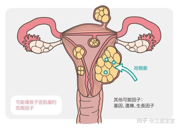 子宫肌瘤会改变宫颈口的方向