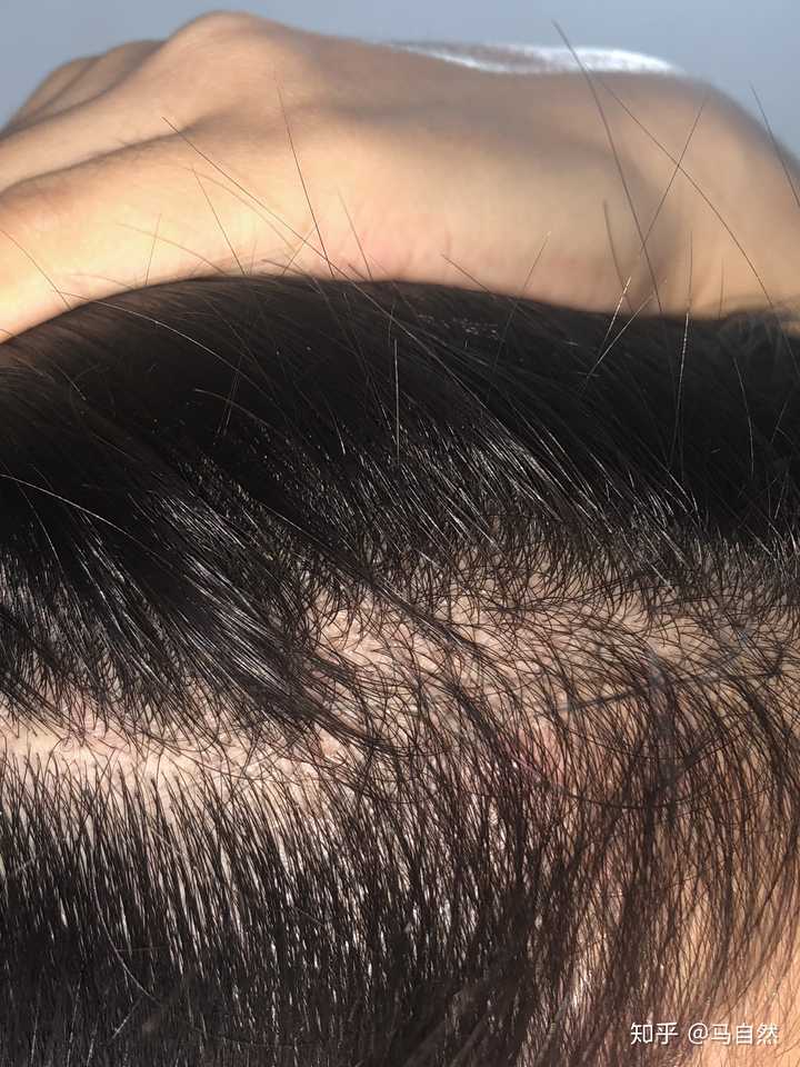 我才20岁脱发严重已经两年了有什么办法是防脱发和生发的吗