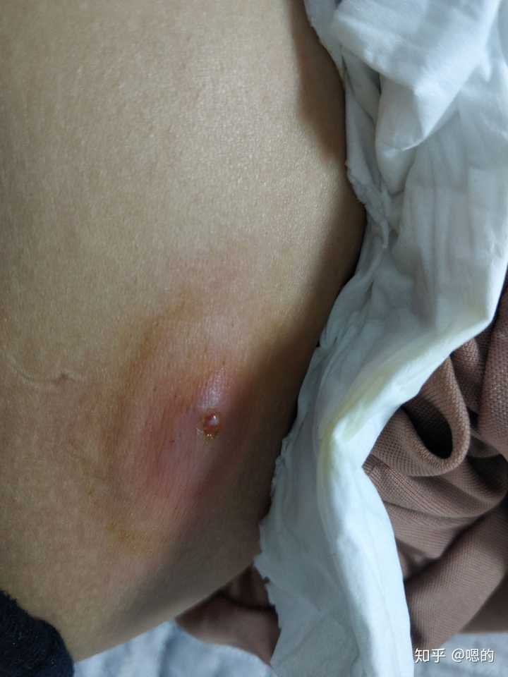 一个火疖子能大到什么地步