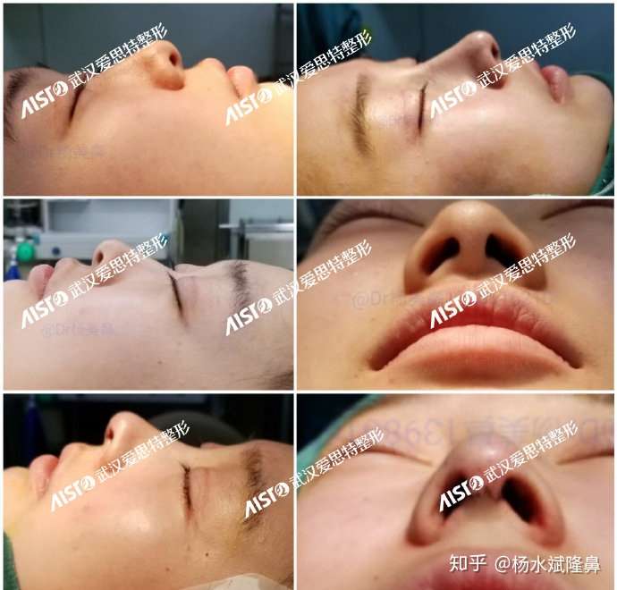 杨水斌肋软骨鼻综合案例分享七