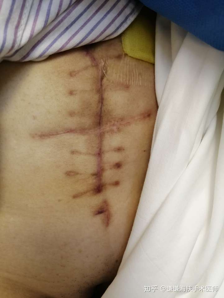 子宫肌瘤手术刀疤图片