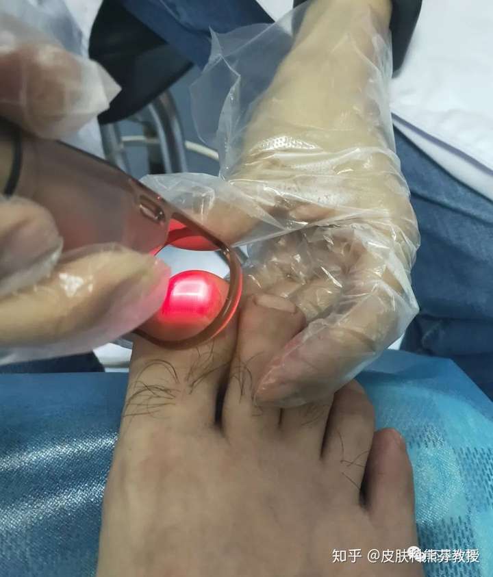 激光配合药物治疗灰指甲