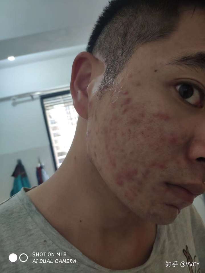痘痘我推荐用中药祛痘膏,我自己就是这样治好的,而且现在吃火锅啊熬夜