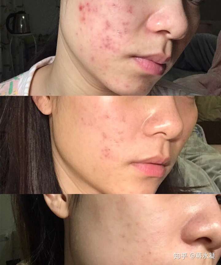 有哪些效果好的祛痘/祛痘印产品? - 知乎