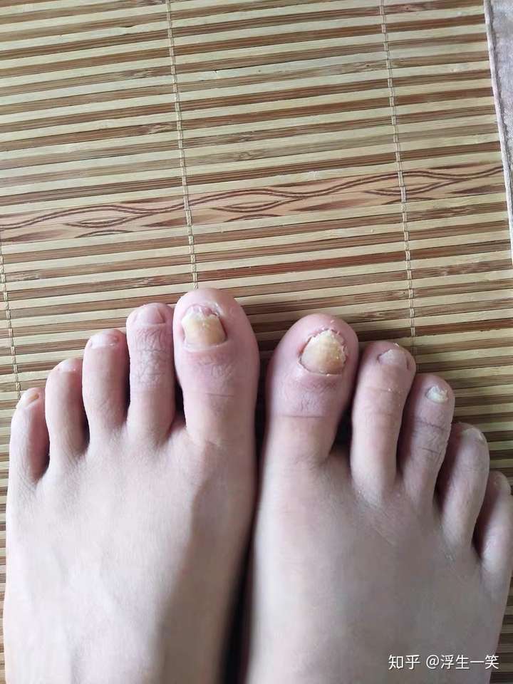 灰指甲很长一段时间了,在网上买了一款神笔用,效果真的不咋滴,没能