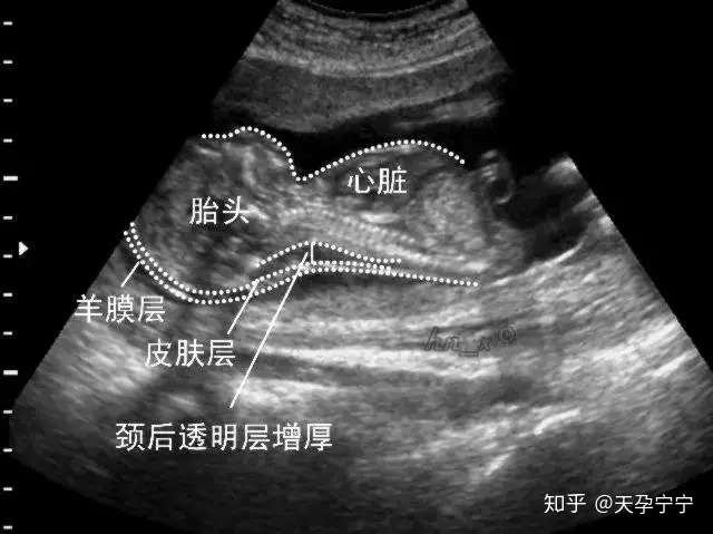 即颈项透明层,指胎儿颈后皮下组织液内液体积聚的厚度