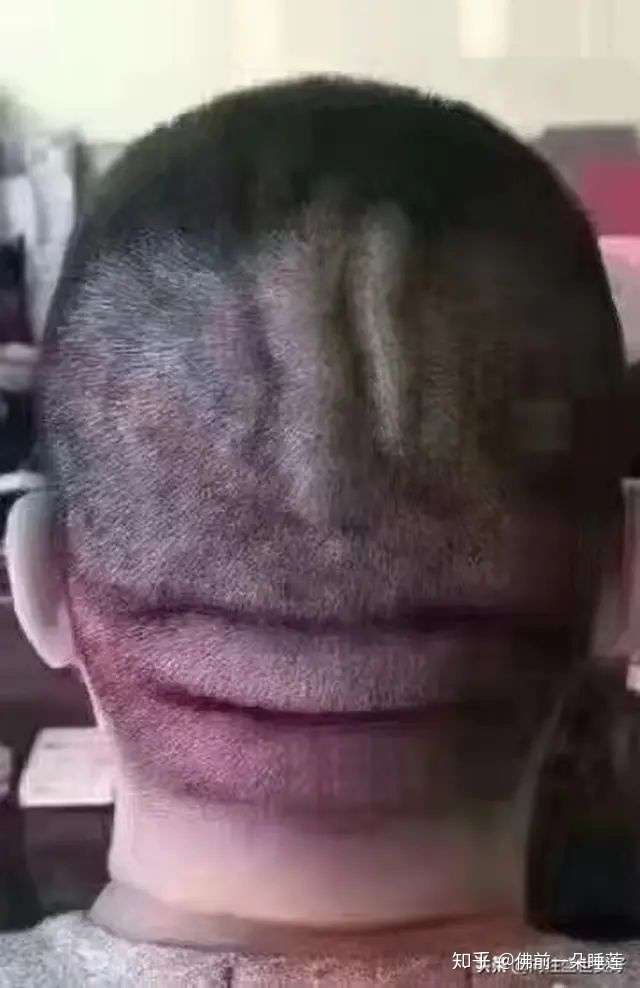 佛前一朵睡莲 横纹是脑梗纹, 竖纹是脑出血纹 不是危言耸听!