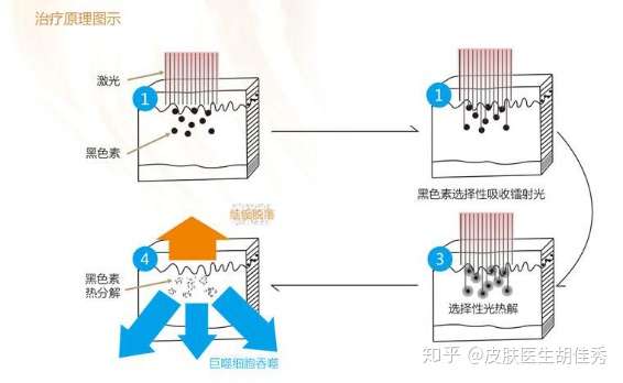 纹身能彻底洗掉吗