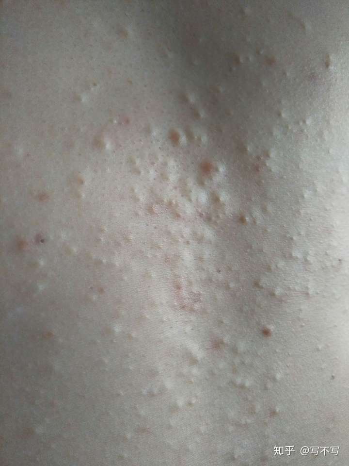 胸口的小疙瘩什么事呀不痛不痒但是很不好看藏脏东西下面有图