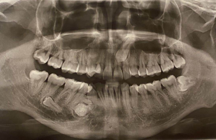 7颗牙的经历分享 苏晓斌 关键词:智齿,阻生智齿,埋伏牙,牙瘤,全身