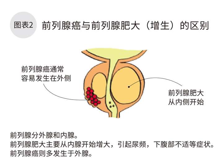 「前列腺」制造部分精液,前列腺癌是发生在男性前列腺上的恶性肿瘤.