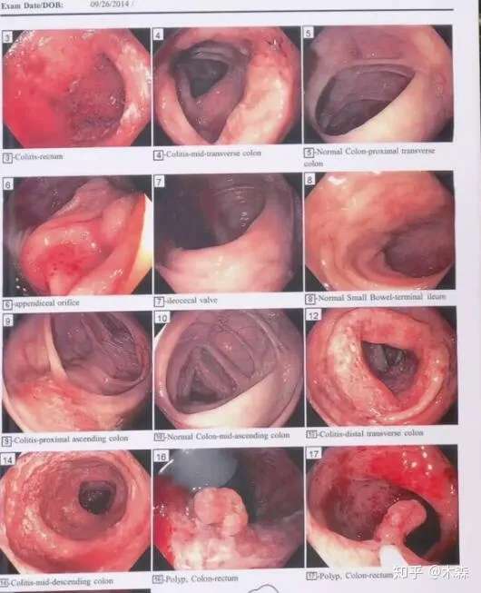 结肠炎照片图图片