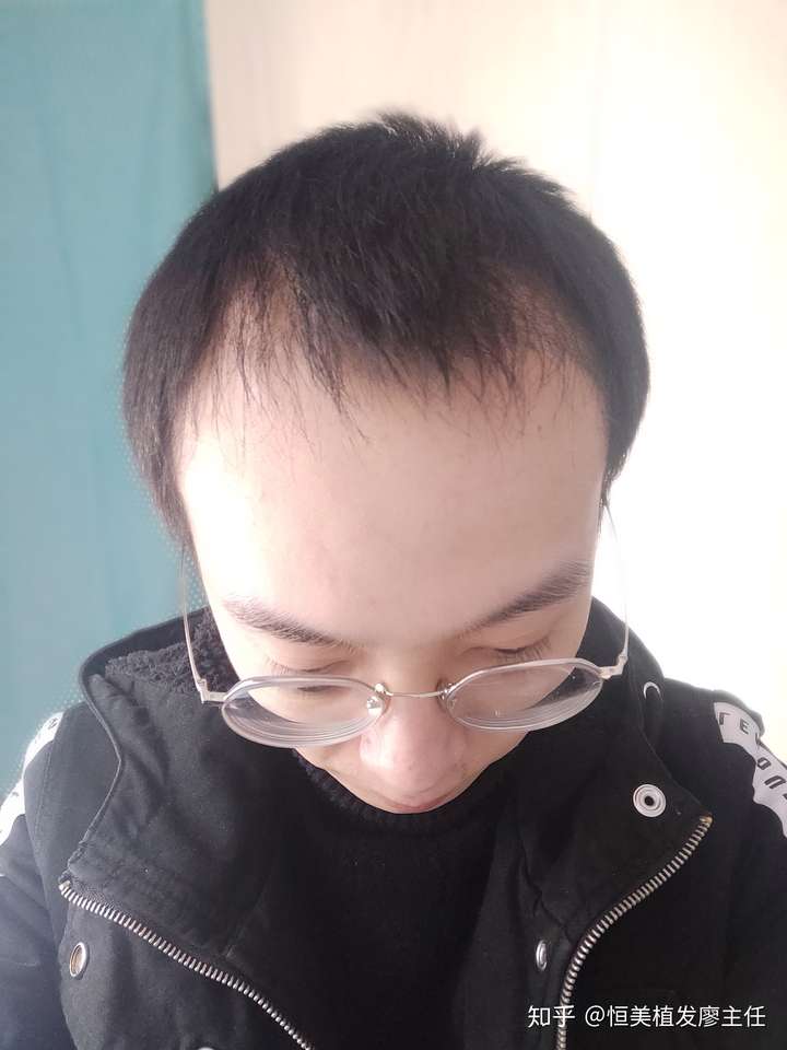 桂林廖植发(桂林181医院有植发的吗)
