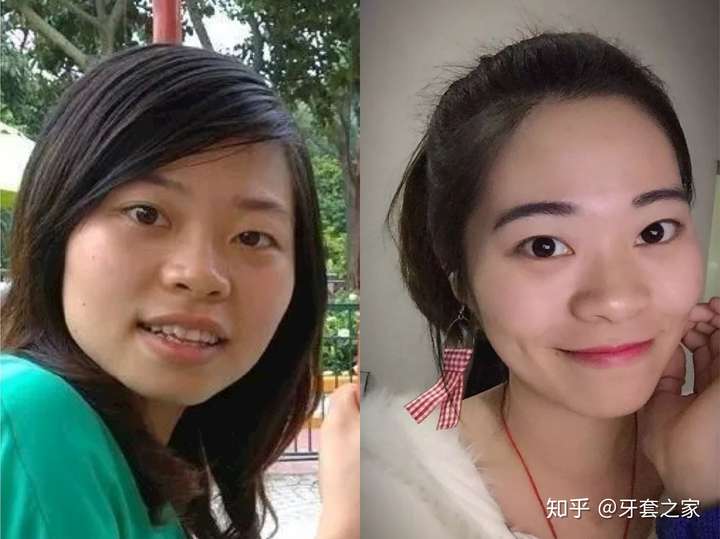 牙套会改变脸型吗?