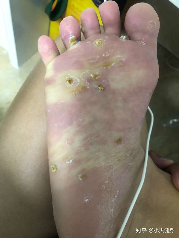 以为是鸡眼用了鸡眼贴,后来疣体越来越大母疣疯狂传染一天长5颗小疣