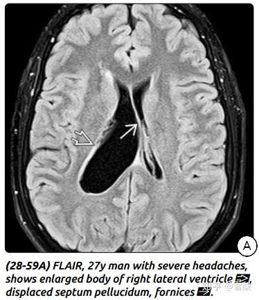 ependymalcyst室管膜囊肿