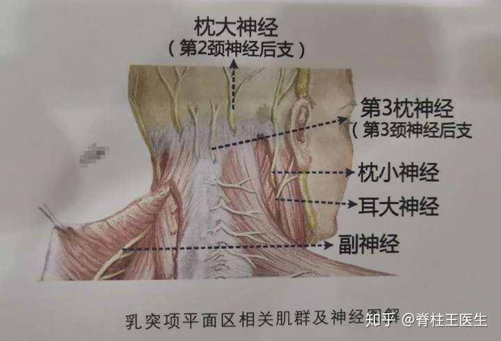 冲击波治疗颈原型头痛颈痛后枕痛顽固性颈部肌筋膜炎新思路