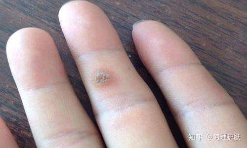 疣的种类及治疗方法