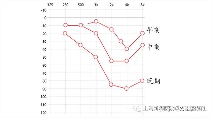 为什么很多听力损失从高频开始