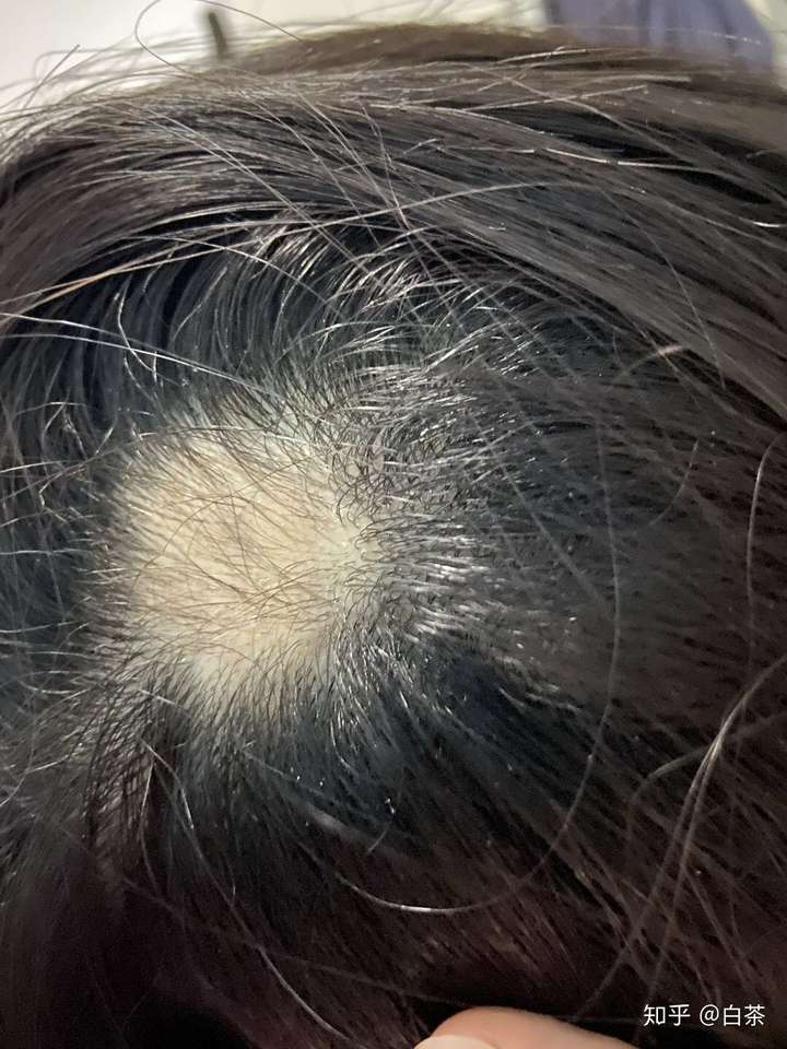 怎样治疗头部脂溢性皮炎(脂溢性脱发头发还能长回来吗)