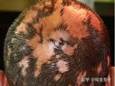 鬼剃头,鬼剃头~ - 知乎