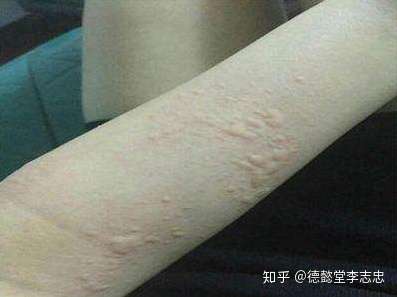 为什么荨麻疹患者不能吃海鲜