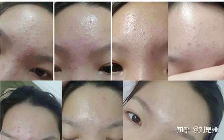 黑头太多  脸颊很多闭口粉刺 暴力去过 怎么改善呢?