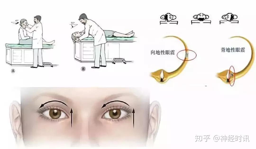 位置性眩晕鉴别要点快来看啦 - 知乎