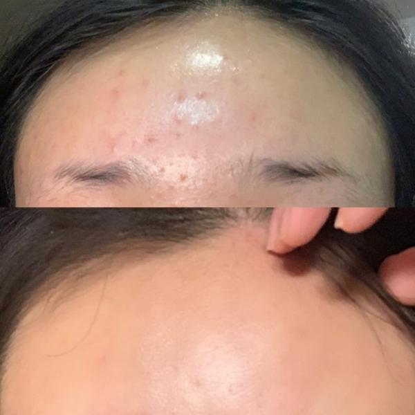 长期使用水杨酸会对皮肤有什么危害吗