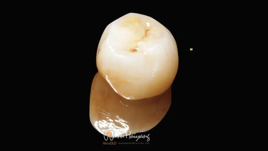 种植一体化氧化锆冠修复单颗后牙缺失1例