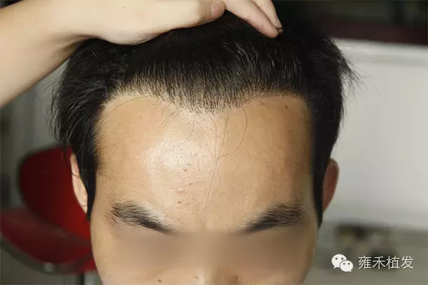 发际线高额头太大最有效的解决办法是不是发际线调整毛发移植?