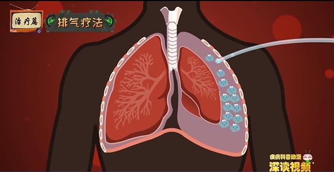 有气胸、肺大泡的童鞋该如何养肺？指南级养肺方式大全 - 知乎