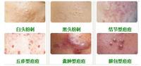 粉刺和痘痘的真正区别在哪里?