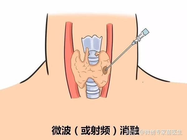 超微创微波消融术轻松解决甲状腺疾病困扰