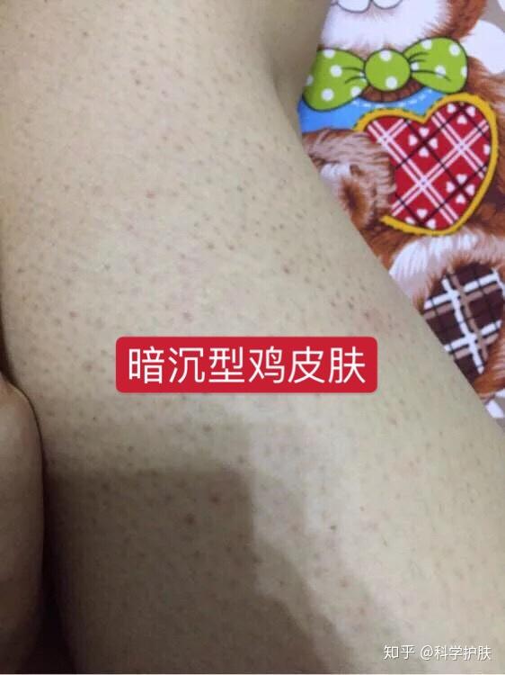 鸡皮肤怎么永久去除鸡皮肤(鸡皮肤怎么永久去除鸡皮肤呢)