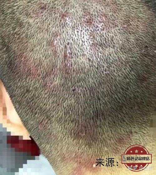 请问得了头部脂溢性皮炎 经常扣那些小疙瘩会怎么样....? - 知乎